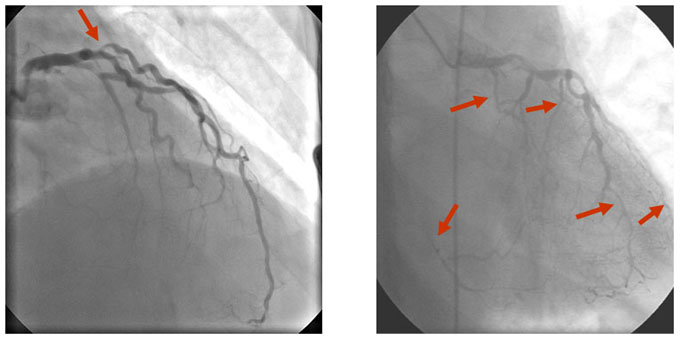 Coronary Artery Disease: While the majority of patients with typical 