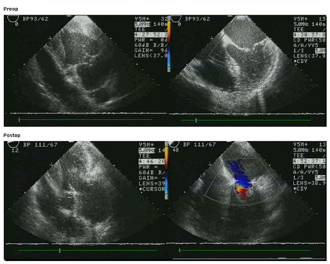 Echocardiography Images. Preoperative (top panel) echocardiography images 