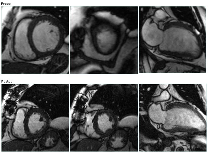 MRI : CABG + CO2 TMR