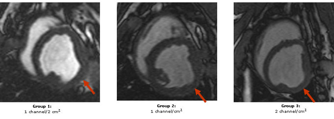 Cine MRI Images: MRI images from animals with coronary occlusions treated with CO2 TMR that demonstrate an improvement in function for Group 1 and 2 (arrow identifies treated area) but a decrease in function when more channels are created (Group 3). 