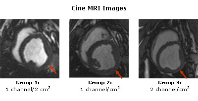 Cine MRI Images: MRI images from animals with coronary occlusions treated with CO2 TMR that demonstrate an improvement in function for Group 1 and 2 (arrow identifies treated area) but a decrease in function when more channels are created (Group 3). 