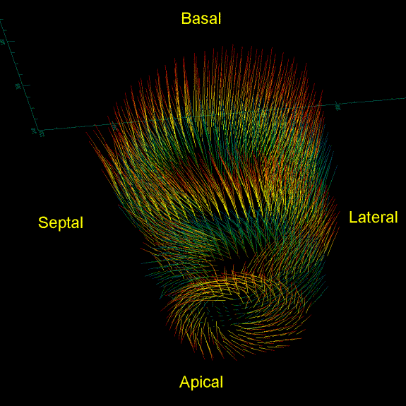 Three-dimensional motion tracking of the left ventricle of the human heart during contraction. The downward movement of the base of the heart toward the apex and the twisting motion of the apex are clearly visible.