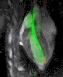 Real-time MRI guided myocardial injection.