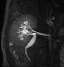 This image is a selective angiogram of a kidney after a catheter is placed in the renal artery using real-time MRI guidance.